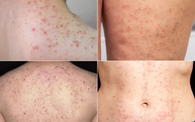 Viêm lỗ chân lông nguyên nhân do đâu? Điều trị phương pháp nào hiệu quả nhanh chóng? - Phòng khám da liễu OHIO Viêm lỗ chân lông nguyên nhân do đâu? Điều trị phương pháp nào hiệu quả nhanh chóng?