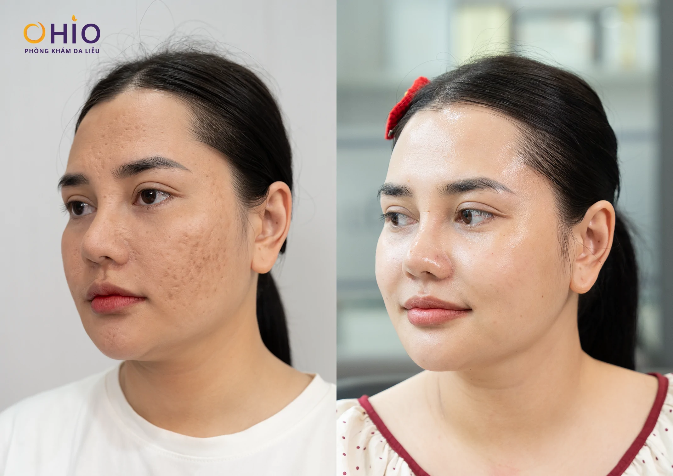 Tại Nghệ An điều trị sẹo rỗ da ở đâu uy tín? - Phòng khám da liễu OHIO Kết quả trị sẹo rỗ của khách hàng tại OHIO