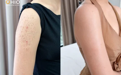 Viêm nang lông điều trị nhiều lần vẫn tái phát? BSCKI Dương Văn Lộc lý giải nguyên nhân - Phòng khám da liễu OHIO Viêm nang lông điều trị nhiều lần vẫn tái phát? BSCKI Dương Văn Lộc lý giải nguyên nhân