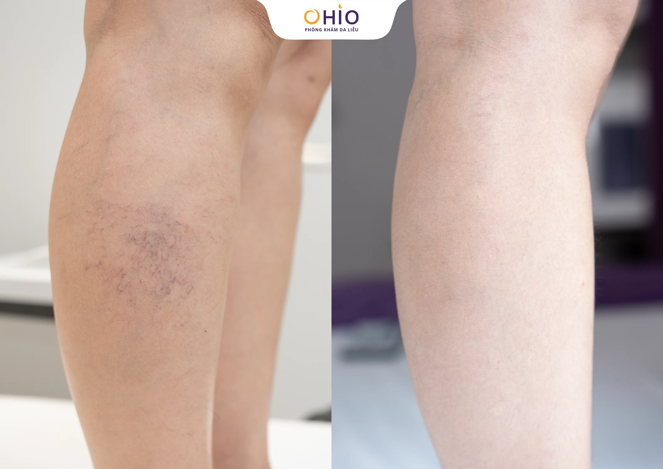 Dấu hiệu giãn mao mạch body là gì? Nguyên nhân và phương pháp điều trị - Phòng khám da liễu OHIO Dấu hiệu giãn mao mạch body là gì? Nguyên nhân và phương pháp điều trị