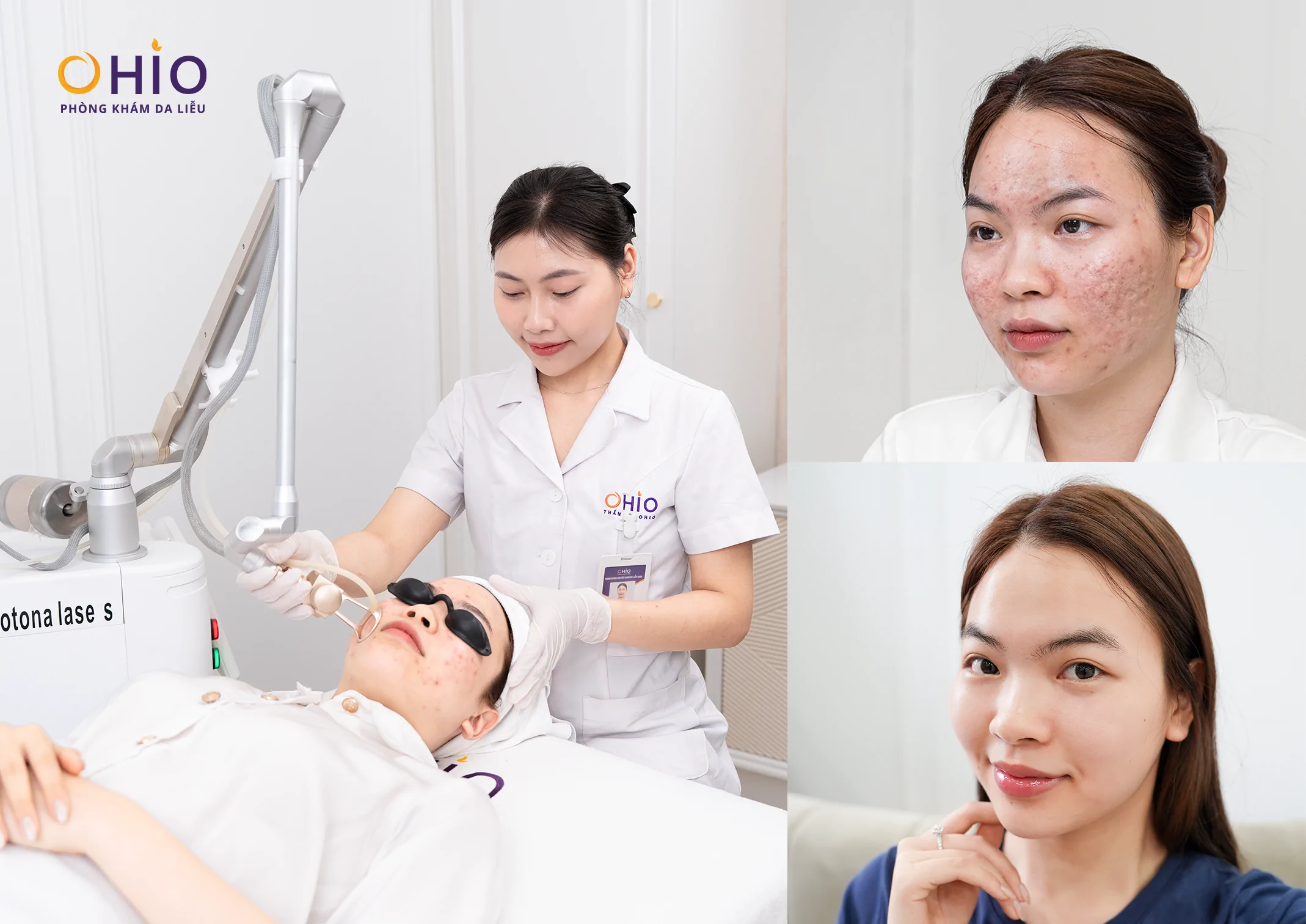Điều trị sẹo rỗ da tại Đà Nẵng chi phí bao nhiêu? - Phòng khám da liễu OHIO Điều trị sẹo rỗ da tại Đà Nẵng chi phí bao nhiêu?