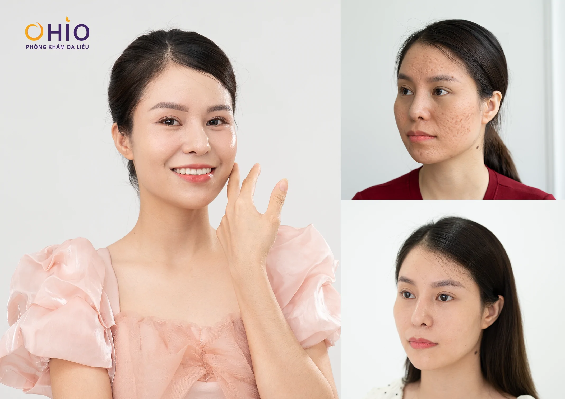 Điều trị sẹo rỗ da tại Đà Nẵng chi phí bao nhiêu? - Phòng khám da liễu OHIO Điều trị sẹo rỗ da tại Đà Nẵng chi phí bao nhiêu?