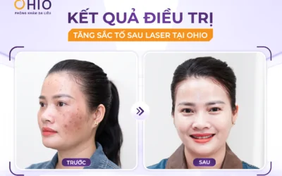 Tăng sắc tố sau laser: Vì sao da thâm sạm hơn sau điều trị và làm thế nào để khắc phục? - Phòng khám da liễu OHIO Tăng sắc tố sau laser: Vì sao da thâm sạm hơn sau điều trị và làm thế nào để khắc phục?