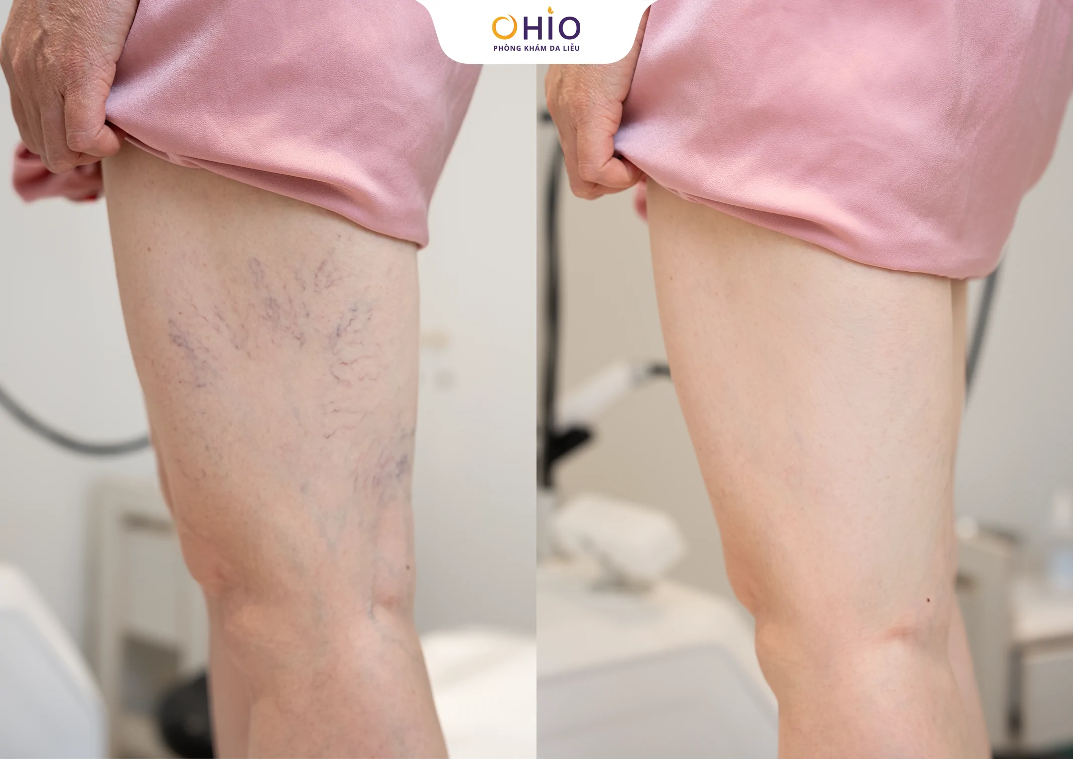 Dấu hiệu giãn mao mạch body là gì? Nguyên nhân và phương pháp điều trị - Phòng khám da liễu OHIO Dấu hiệu giãn mao mạch body là gì? Nguyên nhân và phương pháp điều trị
