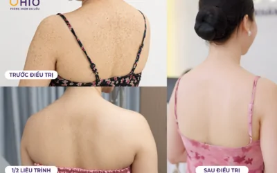 Viêm lỗ chân lông nguyên nhân do đâu? Điều trị phương pháp nào hiệu quả nhanh chóng? - Phòng khám da liễu OHIO Viêm lỗ chân lông nguyên nhân do đâu? Điều trị phương pháp nào hiệu quả nhanh chóng?