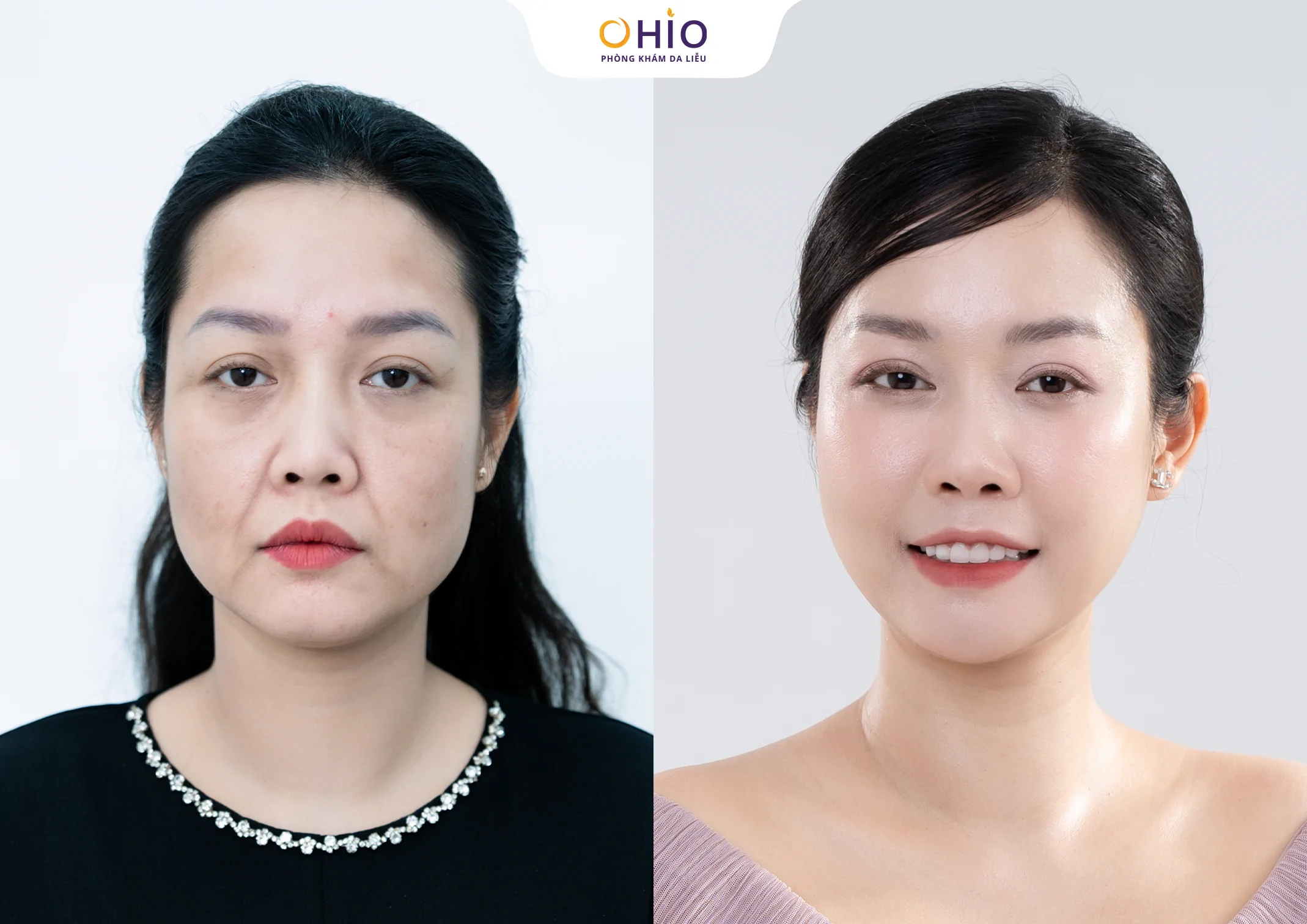 Địa Chỉ Trẻ Hóa Da Tại Vinh An Toàn, Hiệu Quả - Phòng khám da liễu OHIO Địa Chỉ Trẻ Hóa Da Tại Vinh An Toàn, Hiệu Quả